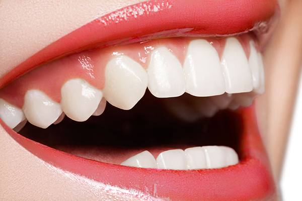 Woodcrest teeth whitening