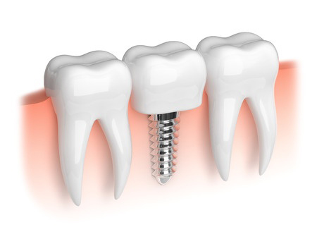 Baltimore dental implants