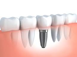 Dental Implants in Englewood