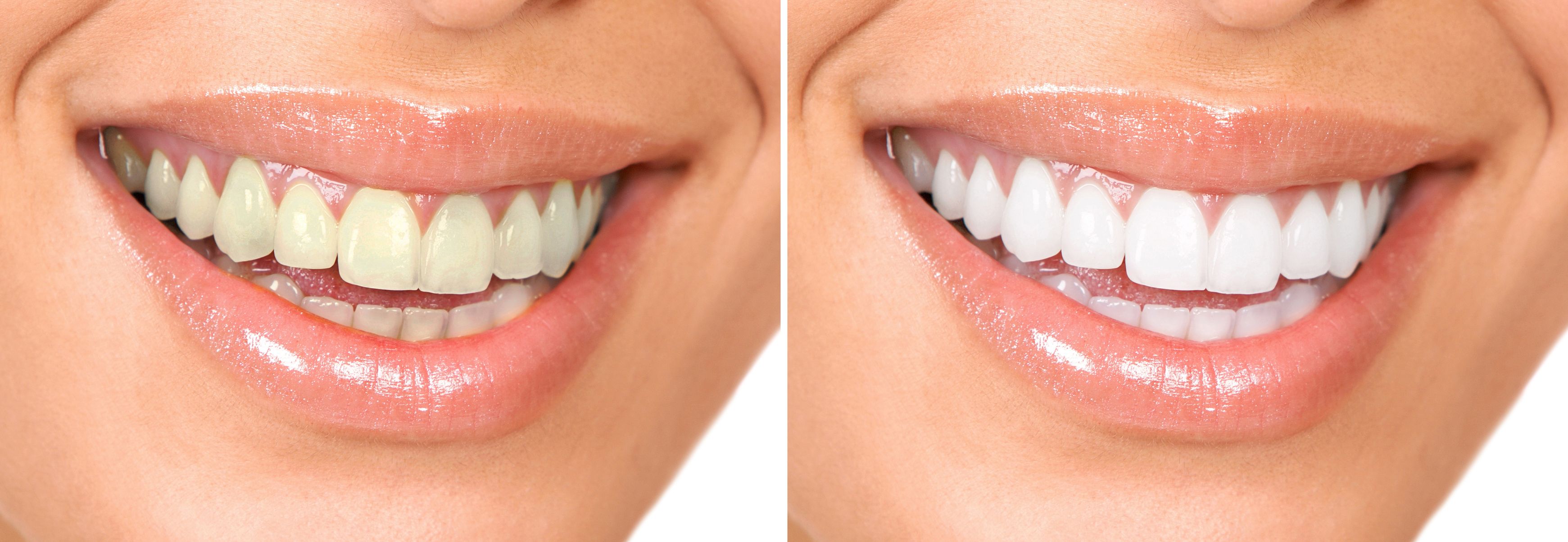 Elmhurst Teeth Whitening