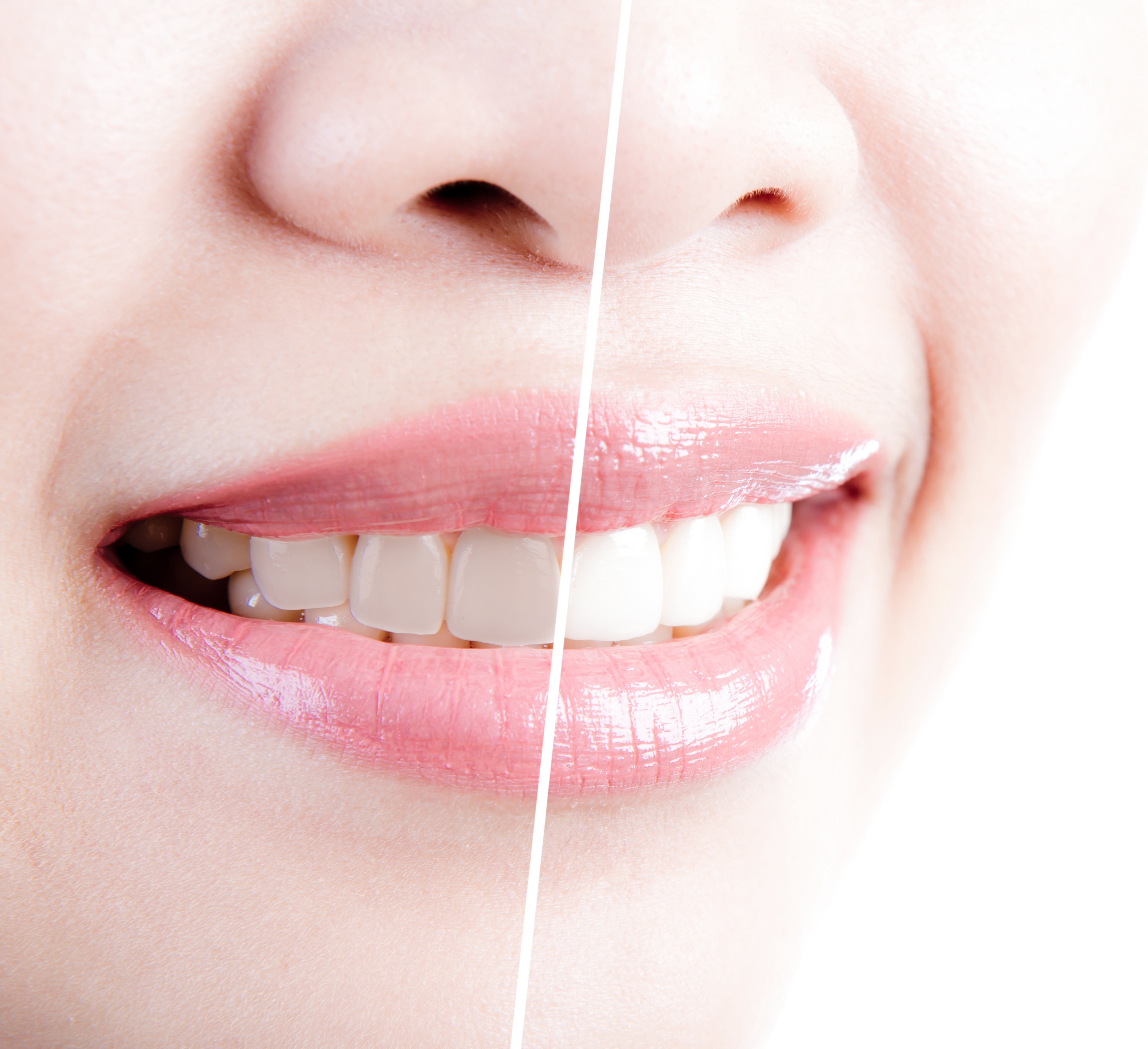 Burlington Teeth Whitening