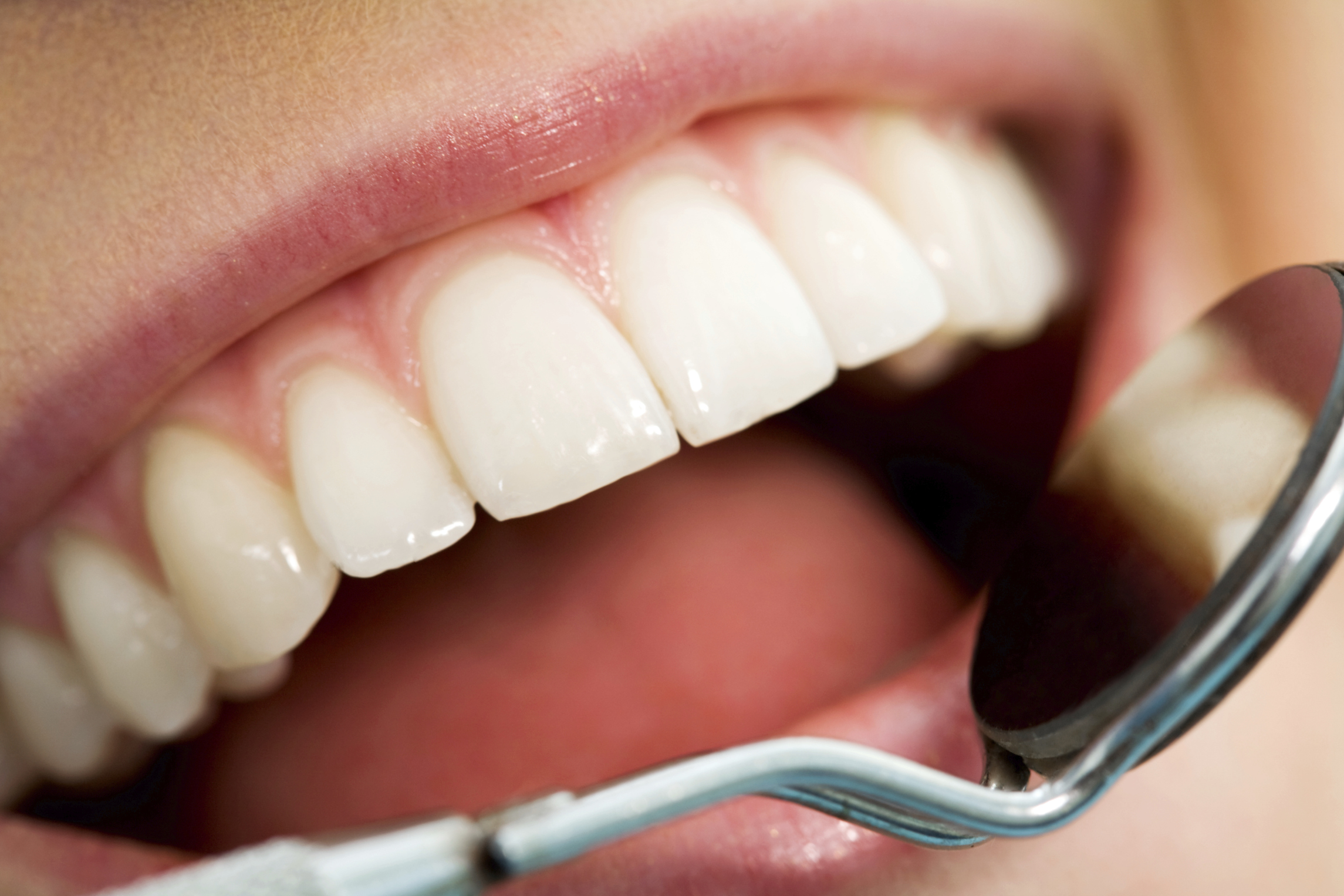 Teeth Whitening in Burlington