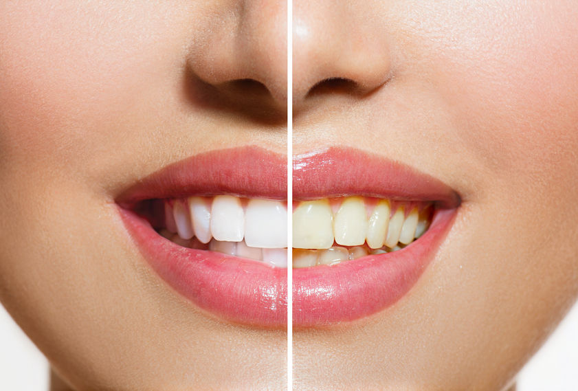Eastpointe﻿ Teeth Whitening