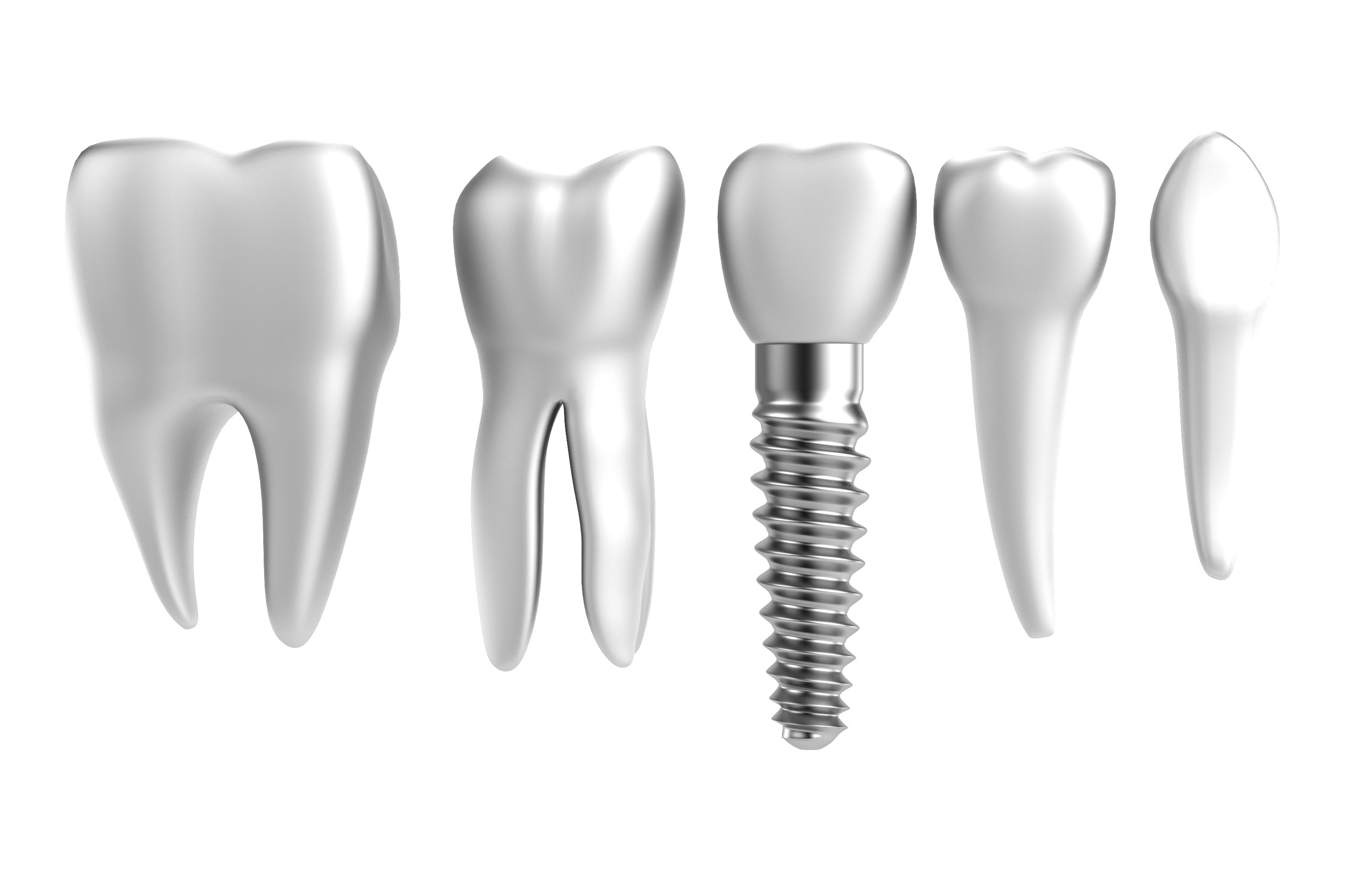 Dental Implants in Palmdale