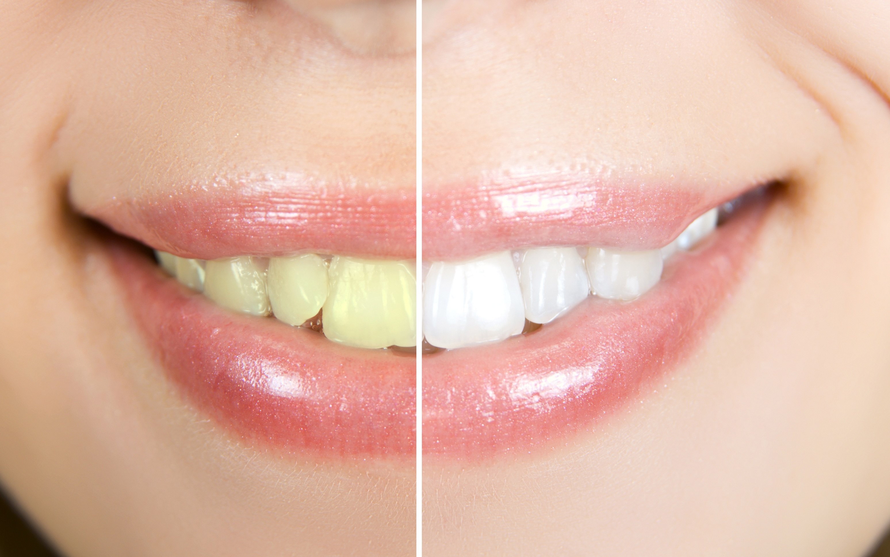 The Loop Teeth Whitening