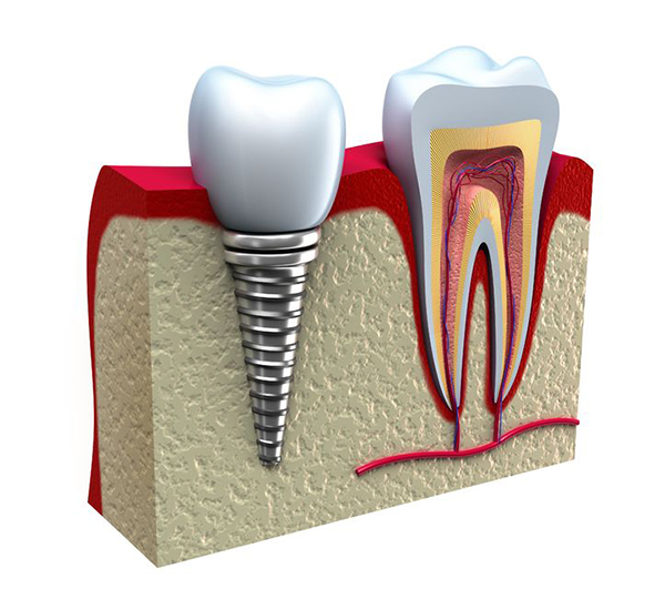 Cypress root canal therapy