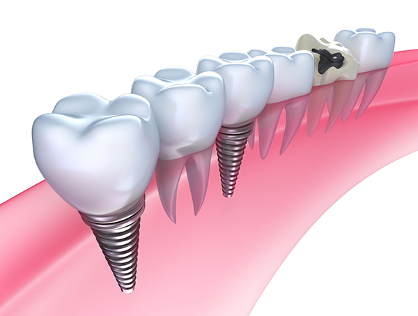 Fremont dental implants