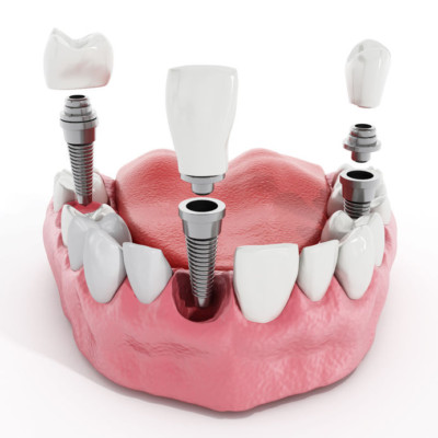Dental Implants in Tribeca