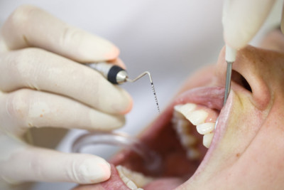 Root Canal in Lockport