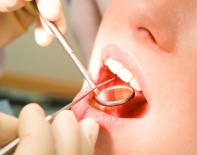 Tooth Extraction in 11021