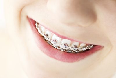 Bayside Adult Braces