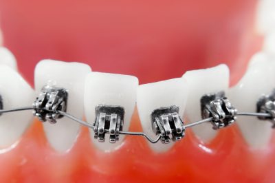 Dental Braces in Little Neck