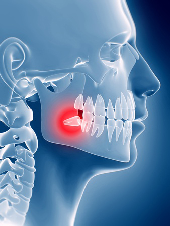 Upper East Side bone graft