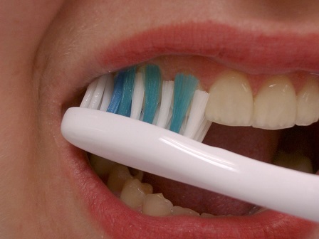 Longboat Key Dental Cleaning
