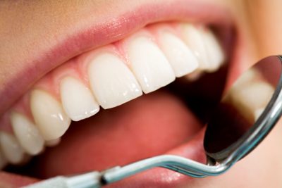 Teeth Cleaning in Staten Island