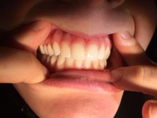 Straight Teeth Last Longer