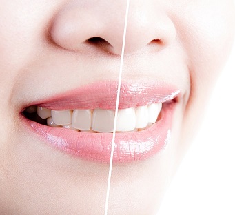 Teeth Whitening Bellevue WA - Pacific Coast Dentist - Dental Bleaching