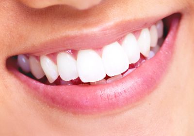 Teeth Whitening in Lebanon MO