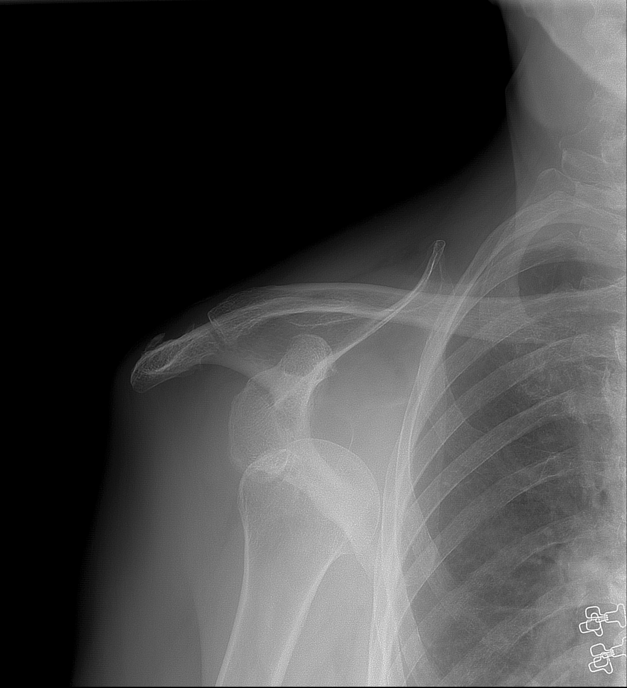 Dislocations of the shoulder and elbow