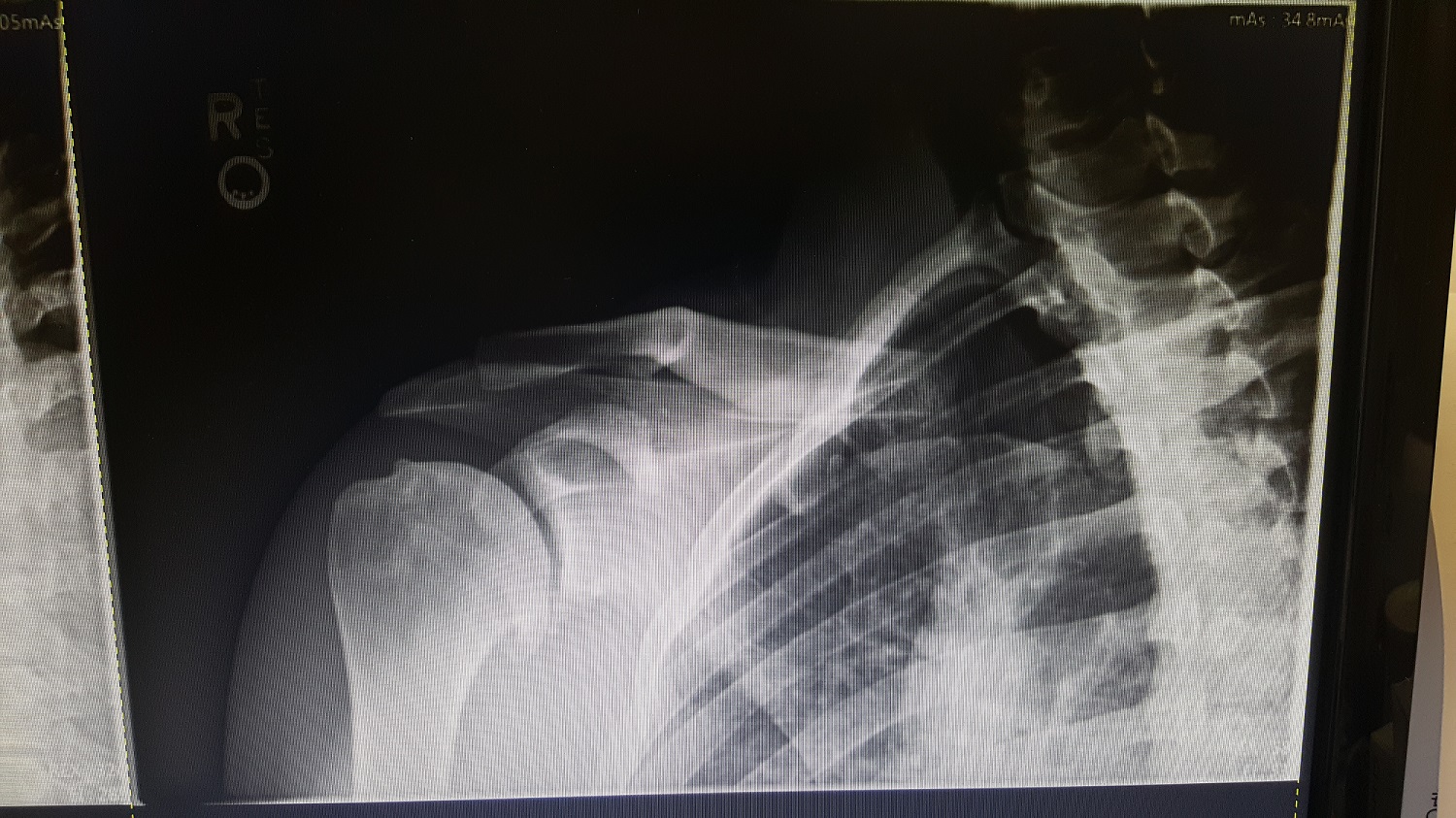 Stemless implants for shoulder replacement