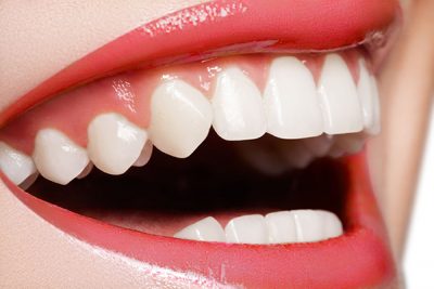 Teeth Whitening in Flemington