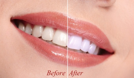 Teeth Whitening in Flemington