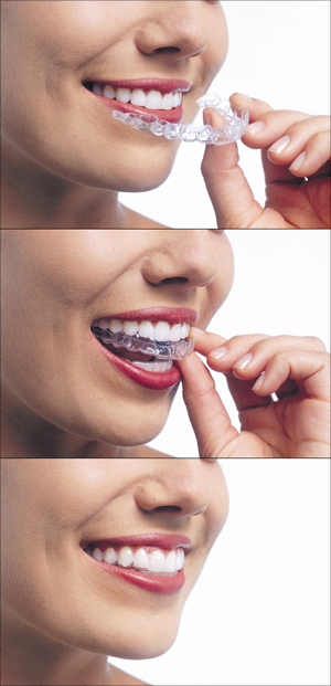 Straighten Your Smile Easily with Invisalign Treatment from Dr. Schramm