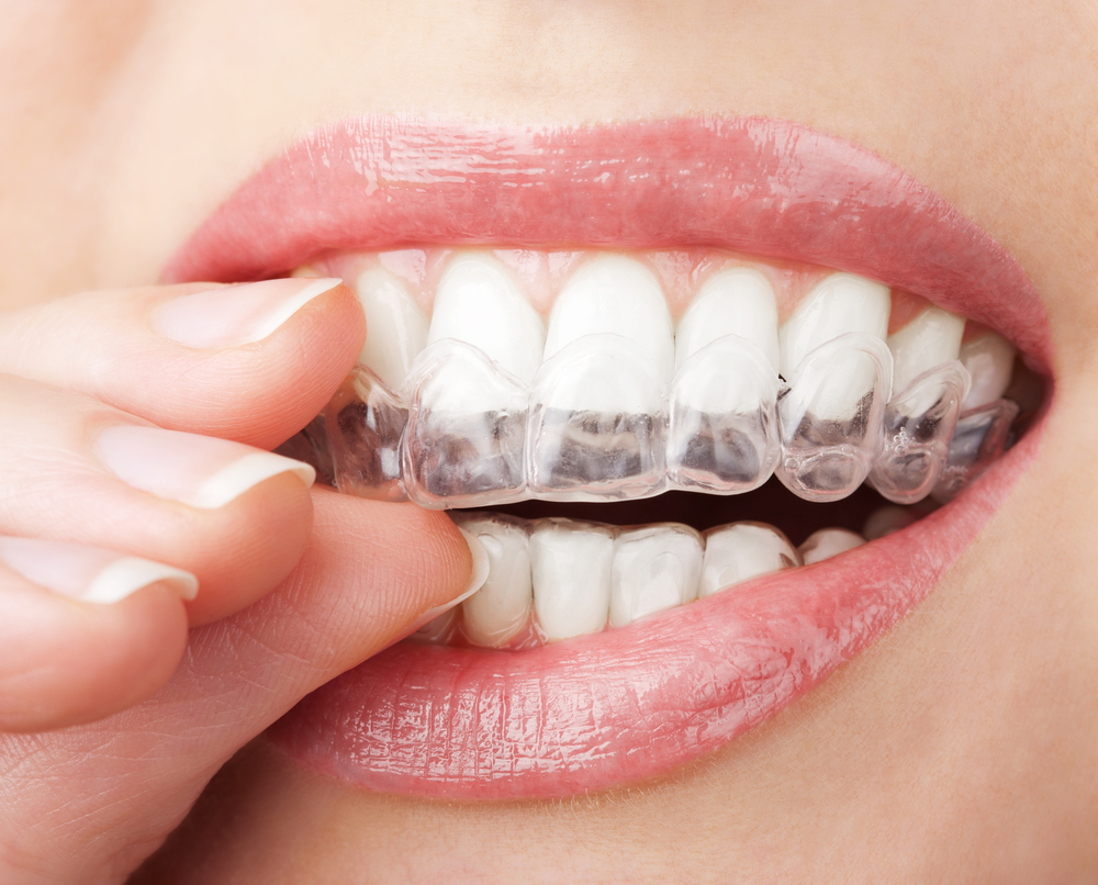 Get a Straighter, More Confident Smile with Invisalign in Charlotte, NC