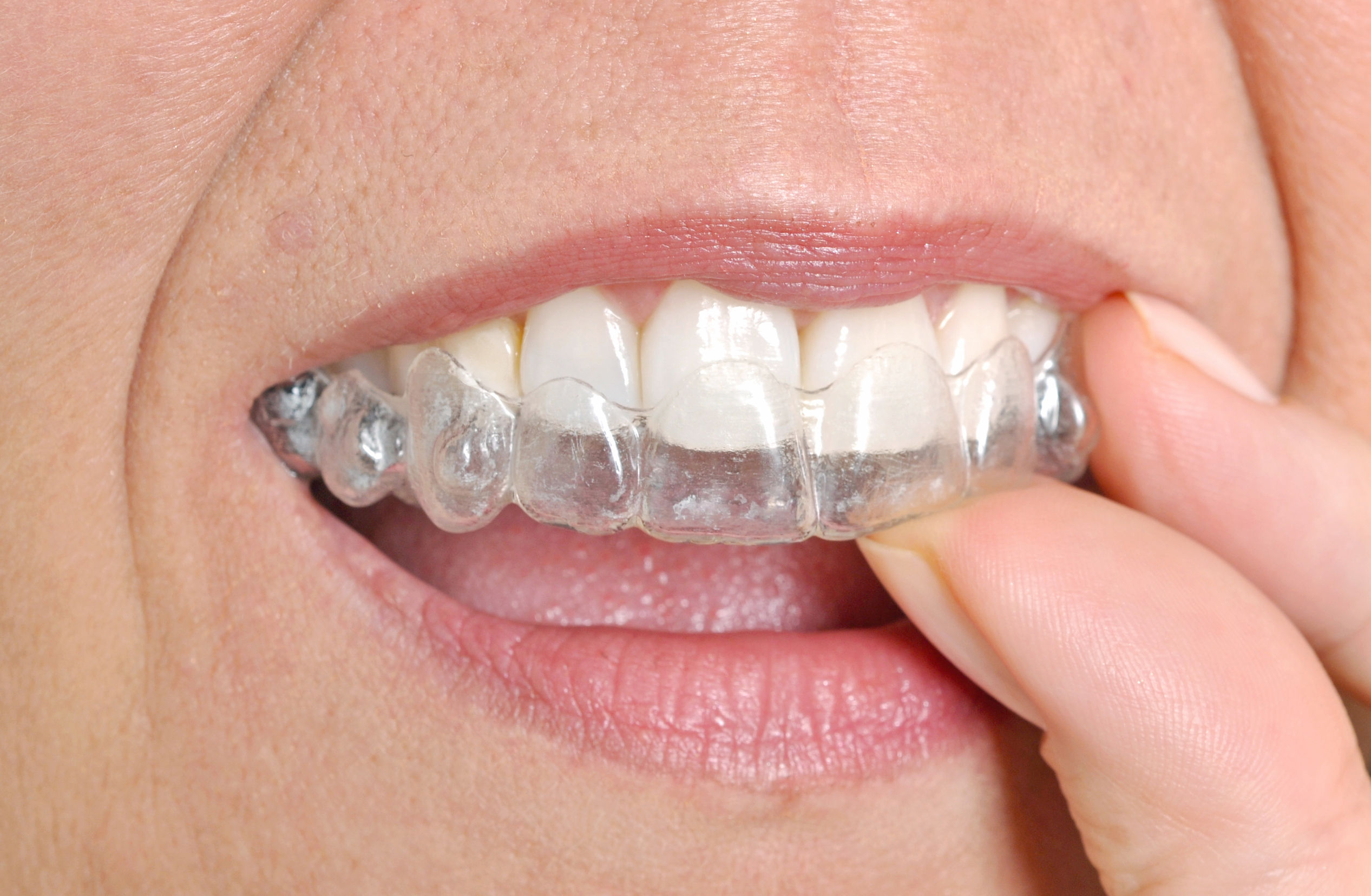 08902 Invisalign