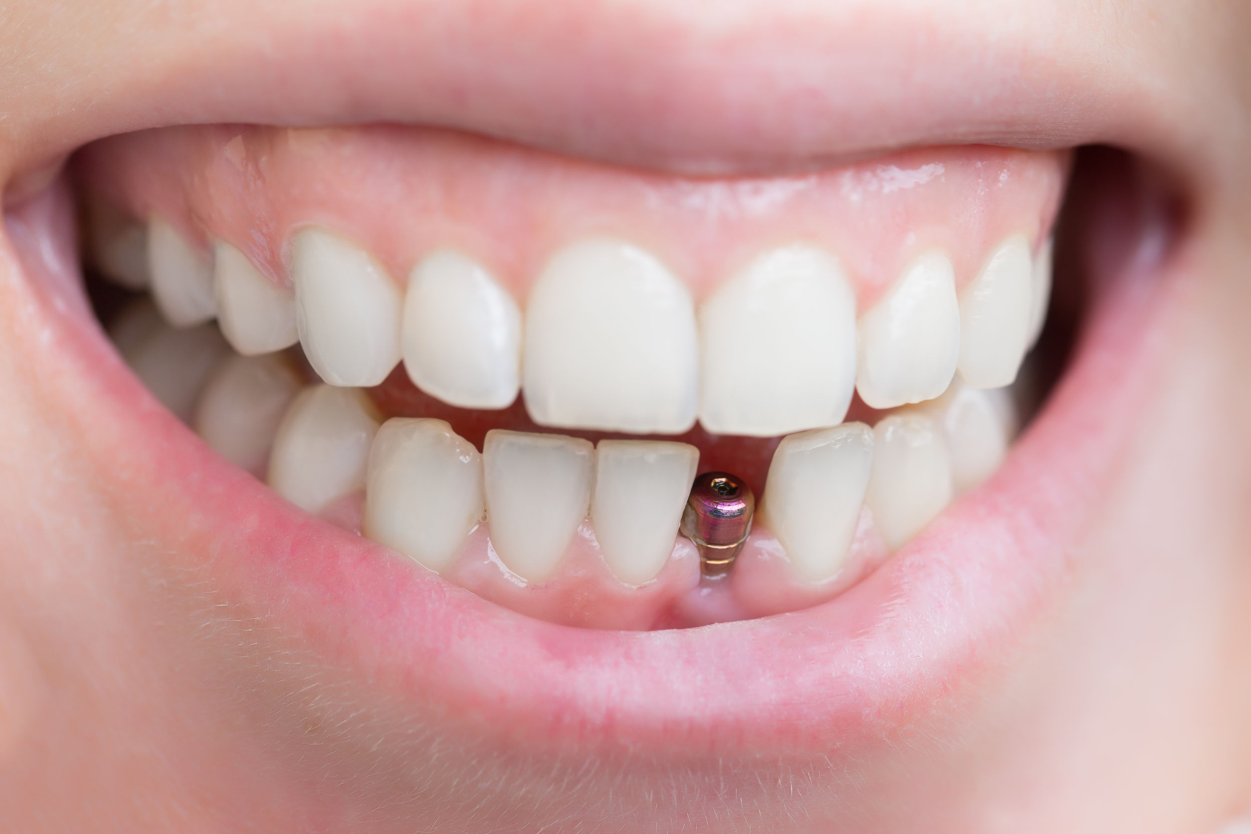 Where Can I Get Bellevue Dental Implants?