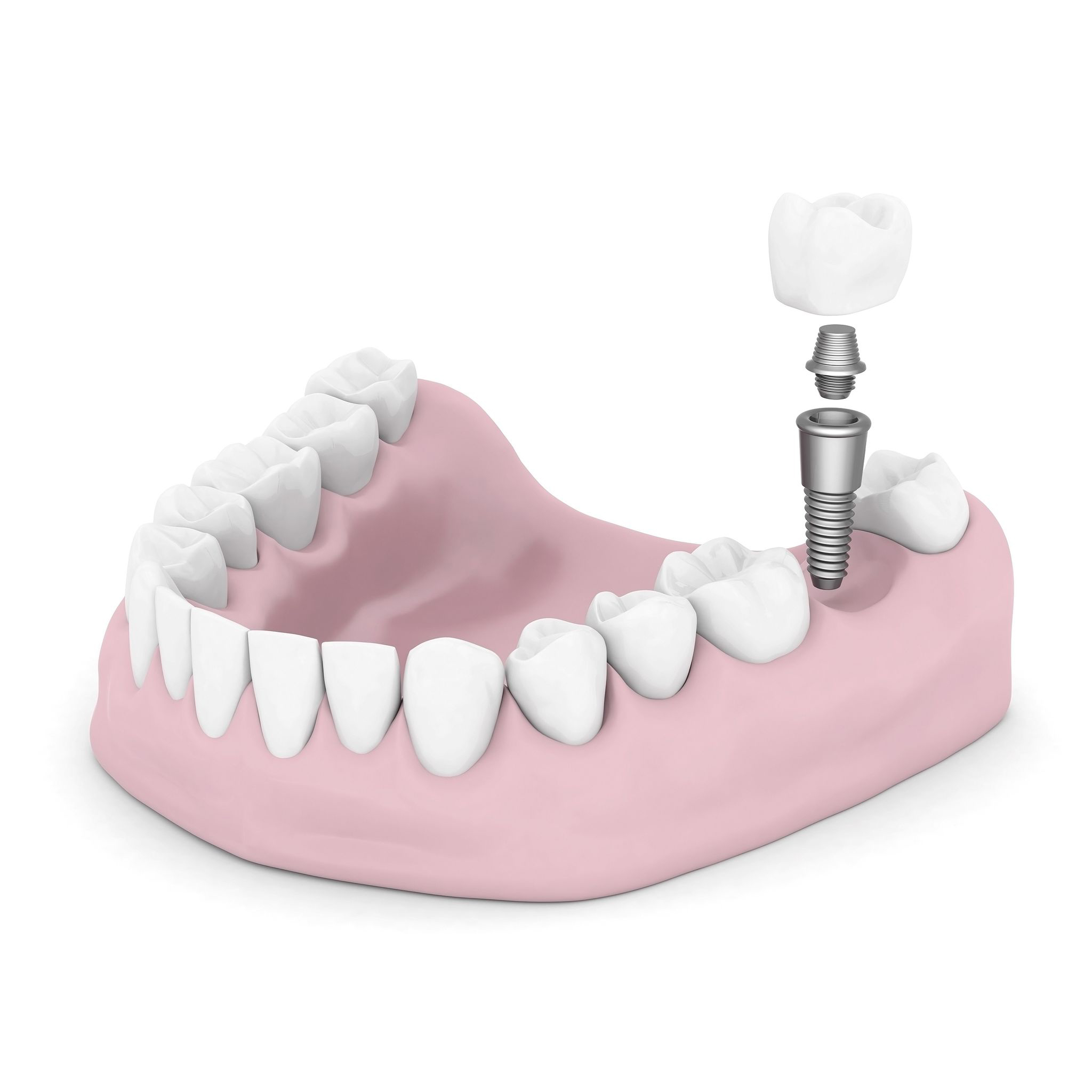 South Pasadena Dental Implants