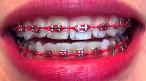 Braces in North Haven