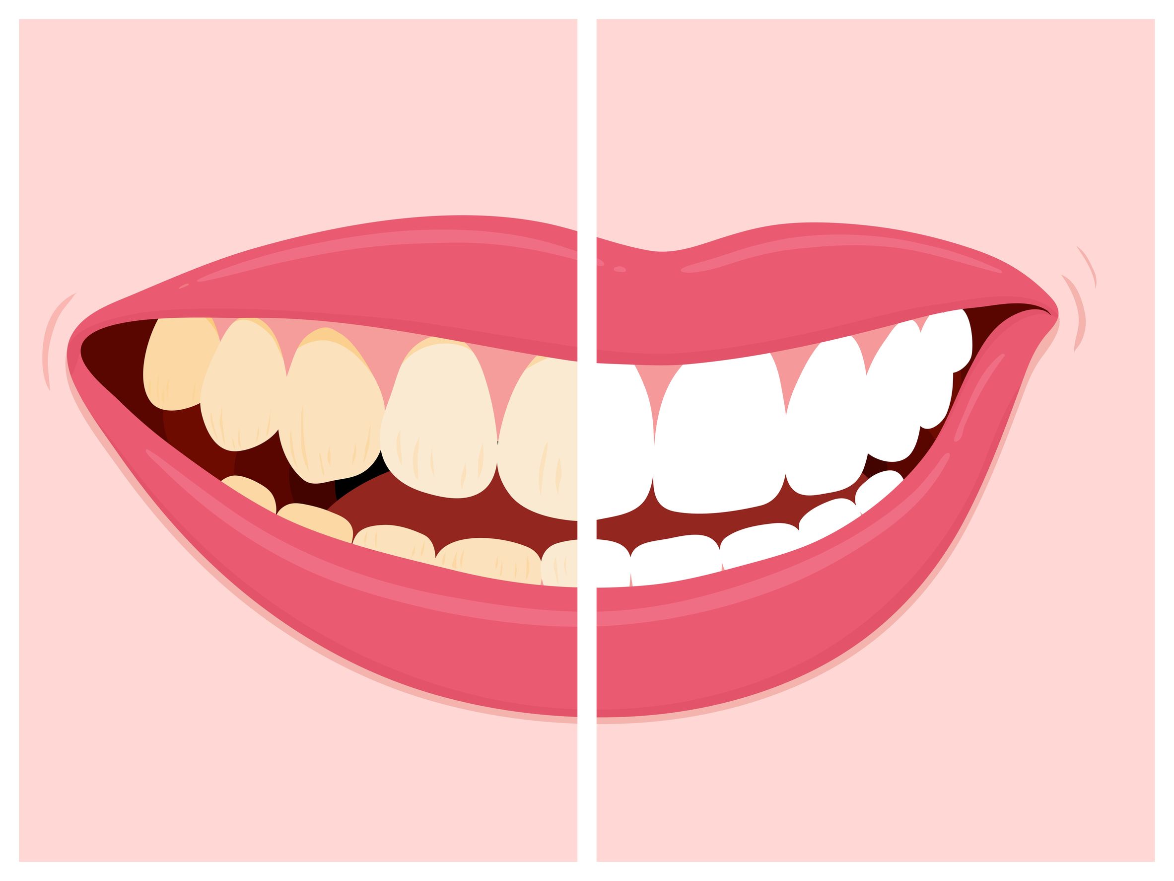 Which Fremont Dentist Can Whiten My Teeth?